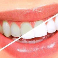 Best Teeth Whitening in Bangalore | teeth whitening cost