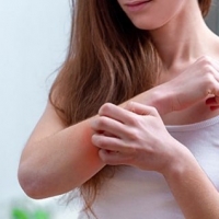 How to treat Demodex itching?