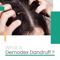 What is Demodex Dandruff ?