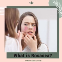 What is Rosacea? ðŸ¤”